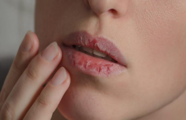 شحوب الشفاه وتساقط الشعر