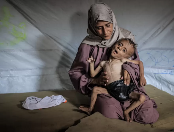 مسؤول طبي: المجاعة خلفت عواقب سيئة على الأم والمواليد الجدد في غزة  
