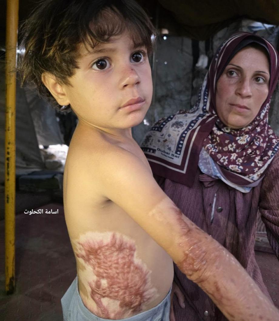 بين رعب القصف والحروق ..  إيلين تنتظر علاجًا ينقذ طفولتها  