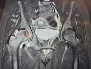 تدخل علاجي نوعي في مستشفى الجامعة لعلاج ورم في رأس عظم الفخذ