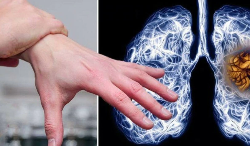 تعجر الأصابع ..  علامة لسرطان الرئة