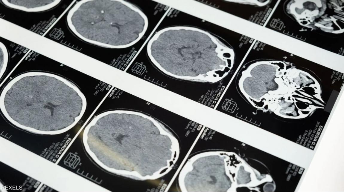الدماغ ليس عضوا واحدا  ..  علماء يكشفون مفاجأة علمية  