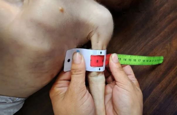 سنتيمترات معدودة ..  أذرع أطفال غزة تختصر حجم مأساة الجوع