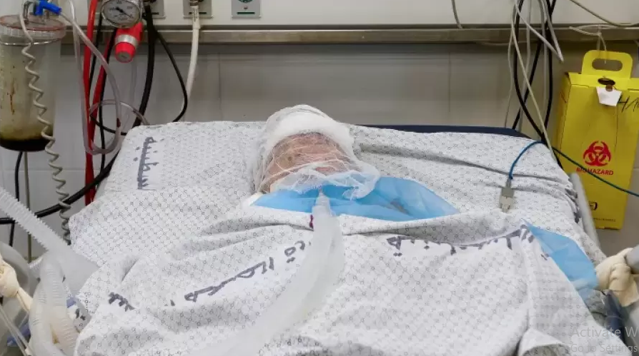 ميرا ..  طفلة فقدت عظم رأسها وحلم الطفولة في أتون الحرب