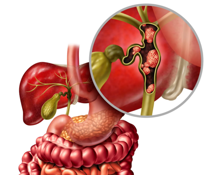 مسار جديد لعلاج سرطان الكبد العدواني