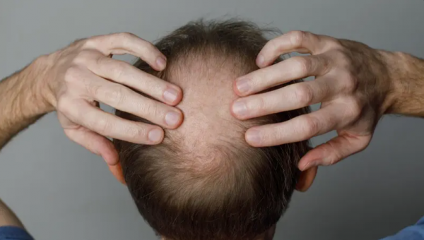 عشبة عمرها ألف عام قد تحمل مفتاح علاج الصلع نهائياً