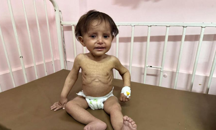 محمد زنون ..  رضيع وُلد في الحرب وتطارده أمراض الجوع 