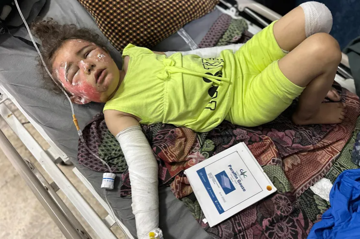 إصابات الحروق القاتلة بلا علاج في غزة