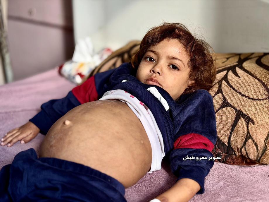 طفلة تواجه الموت بصمت وسط انهيار الرعاية الصحية في غزة 