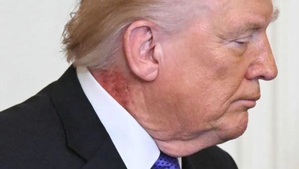 "بقعة حمراء" في رقبة ترامب تثير التكهنات