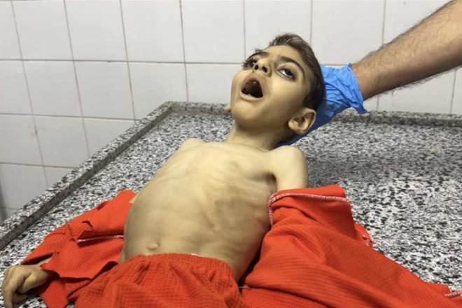 المنظمات الأهلية: 900 ألف طفل في غزة يعانون من سوء التغذية 