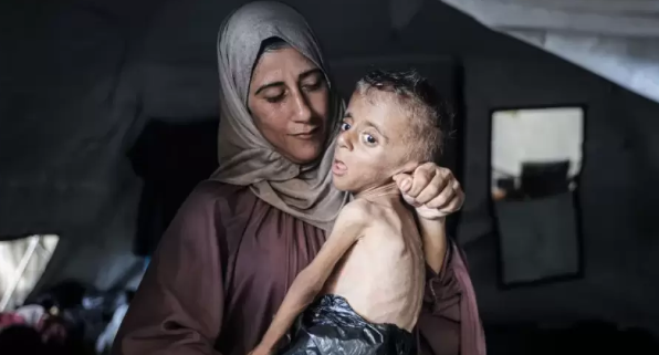 "هيكل عظميّ صغير" ..  المجاعة تفتك بجسد الطِّفل محمَّد المطوَّق  