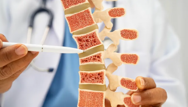 هشاشة العظام في رمضان  ..  التعويض الآمن والمدروس