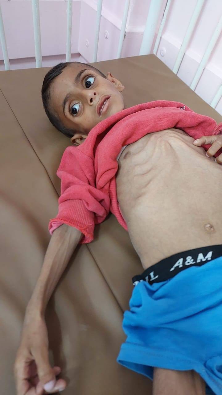 مدير مستشفى ناصر: أطفال غزة في أخطر مراحل سوء التغذية