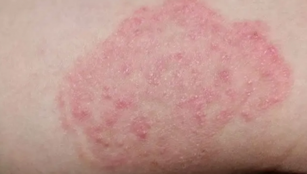 الصبيحي: الفطريات مرض مهني للعاملين في القطاع النباتي والحيواني