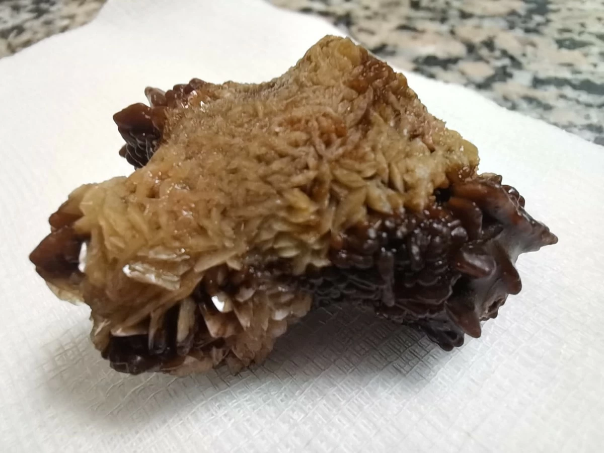 نجاح عملية نوعية لاستخراج حصوة من كلية مشوّهة في مستشفى النديم