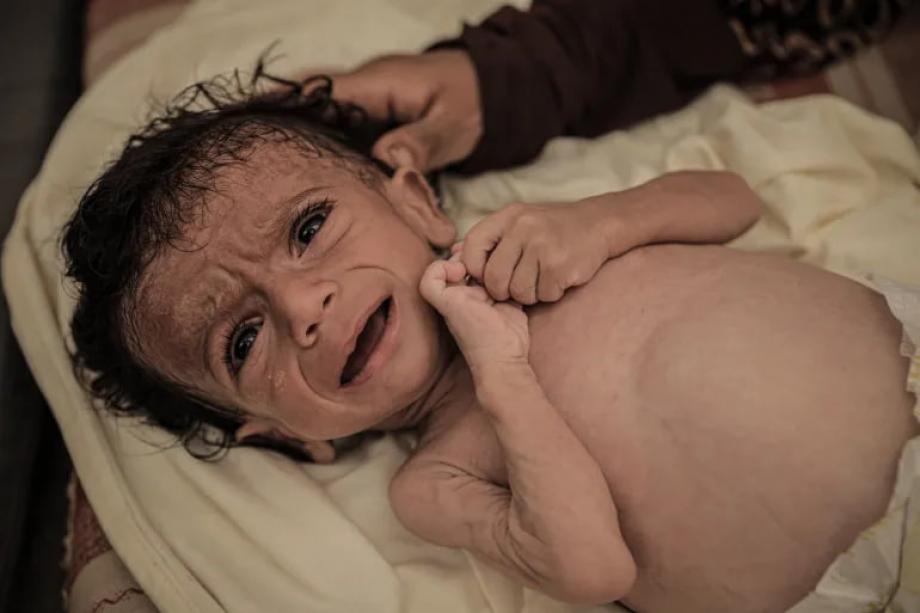 صحة غزة: تسجيل 7 وفيات جديدة بالمجاعة خلال 24 ساعة  