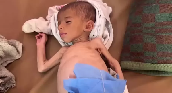 حالتا وفاة خلال الـ 24 ساعة الماضية جرَّاء التَّجويع وسوء التَّغذية  