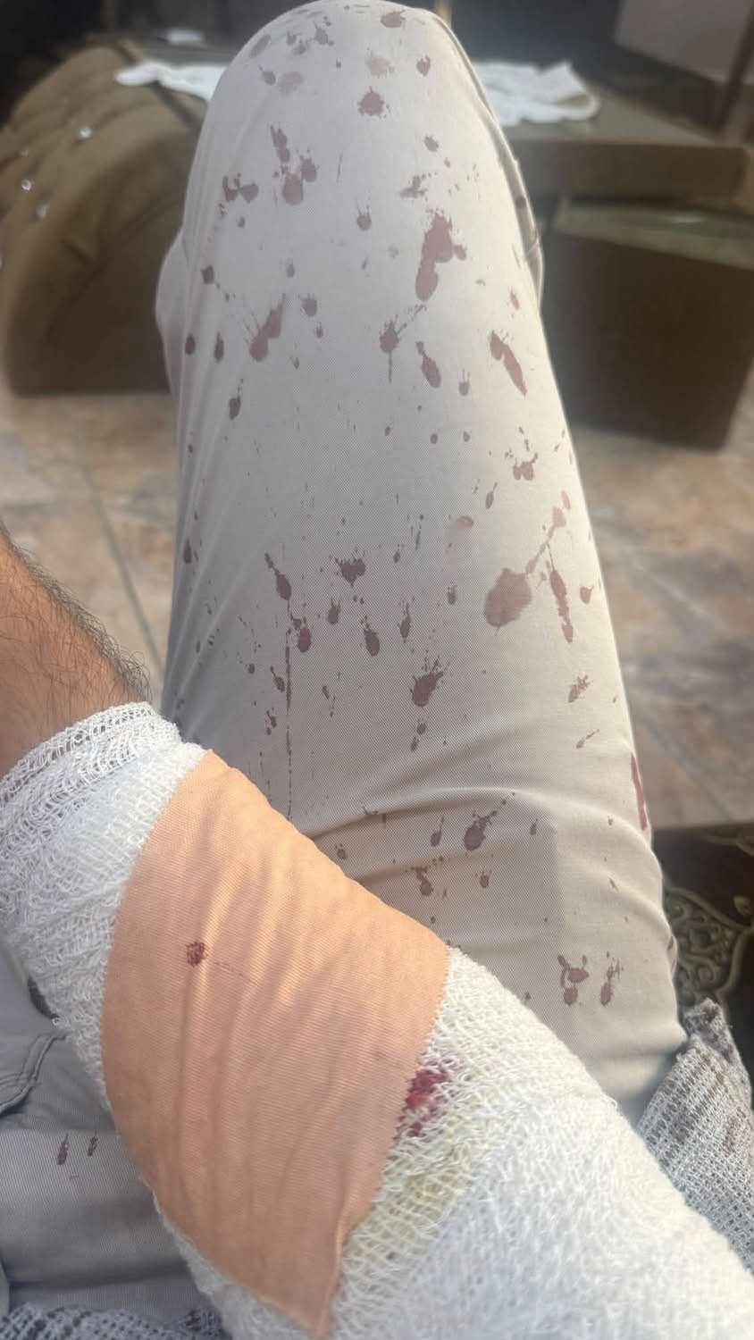 طالب يعتدي على معلم بمنشار بعد انتهاء الدوام  