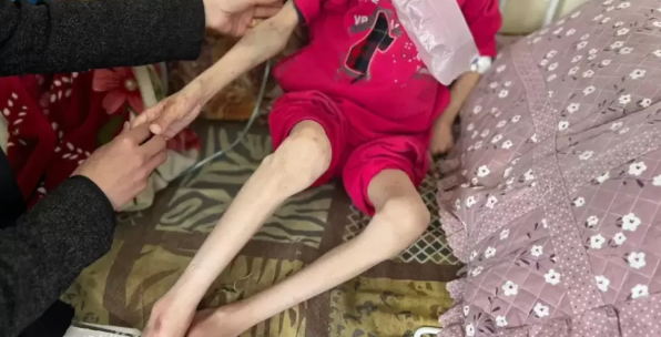 خلال 24 ساعة ..  18 حالة وفاة بسبب المجاعة في غزَّة  