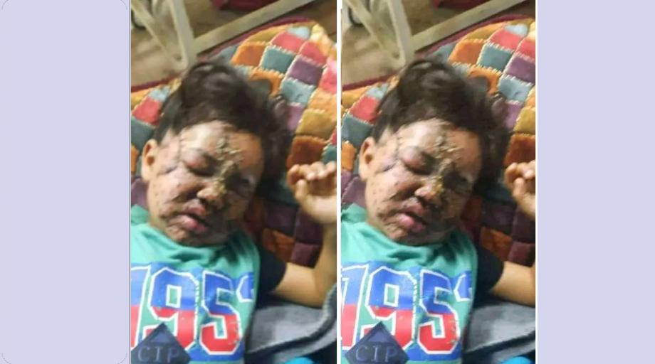 آدم أبو حليب… طفل يصارع الألم والتشوه وحرمان حضن الأم  