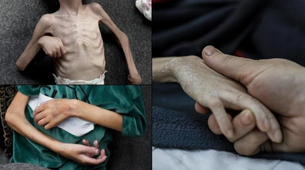 مدير الإغاثة الطبية بغزة: 17 ألف طفل يعانون من سوء تغذية حاد  