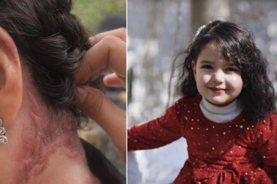 جلدها يحترق مرتين… شهد الباز طفلة تصارع الحروق والمجاعة في خيمة نزوح 