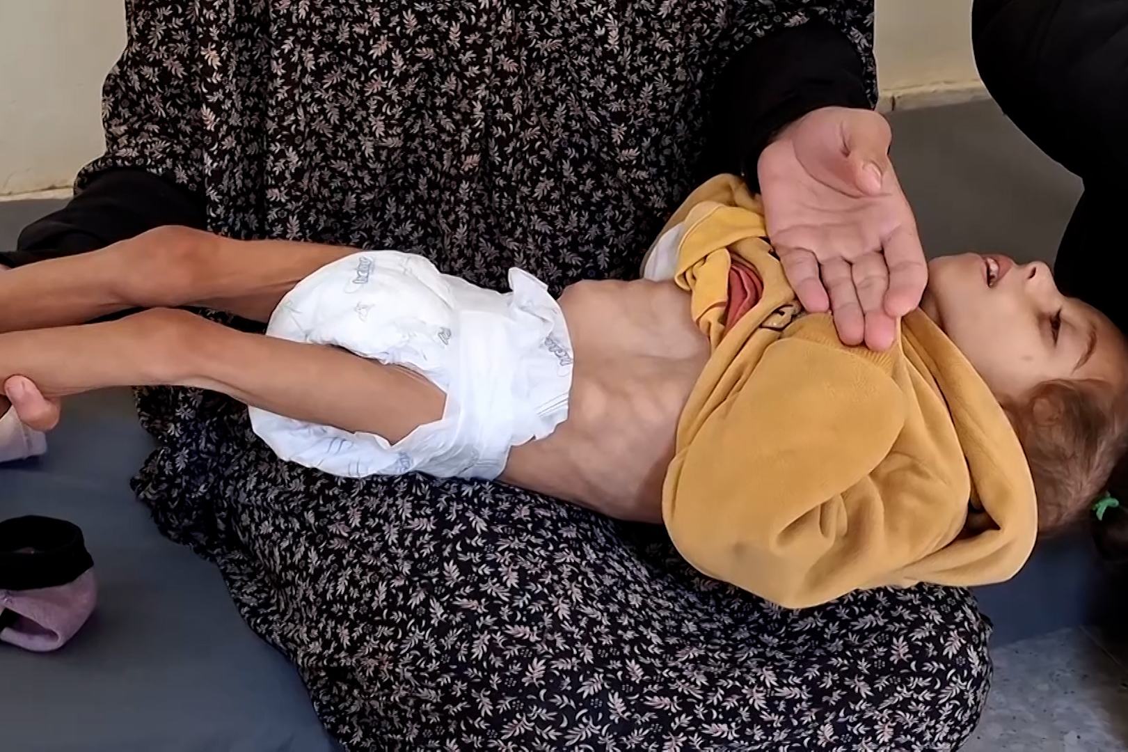 استشهاد طفلة رضيعة بسبب سوء التغذية