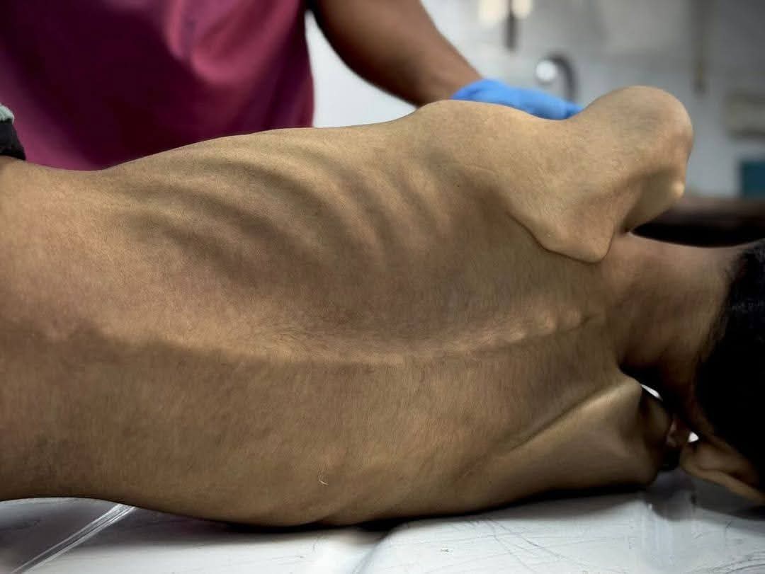 وفاة طفلين شمال وجنوب قطاع غزة بسبب سوء التغذية والمجاعة