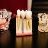 استبدال الأسنان المفقودة يحمي الدماغ والقلب