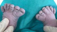 سيدة روسية أنجبت للمرة الثالثة طفلا بـ12 إصبعا في قدميه