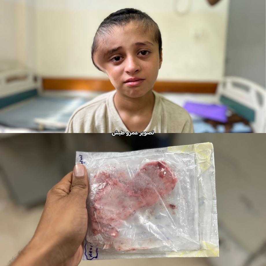 جمجمة "مريم" في المستشفى وروحها عالقة بخيمة لا تحتمل الحياة  