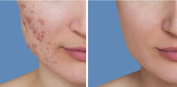 نصائح للعناية بالبشرة والوقاية من حب الشباب