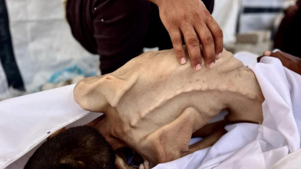 ارتفاع ضحايا المجاعة في غزة إلى 162 شهيدًا بينهم 92 طفلاً  