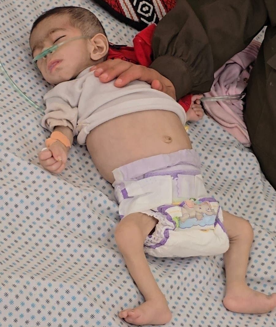 المجاعة تودي بحياة طفلة في مدينة غزة