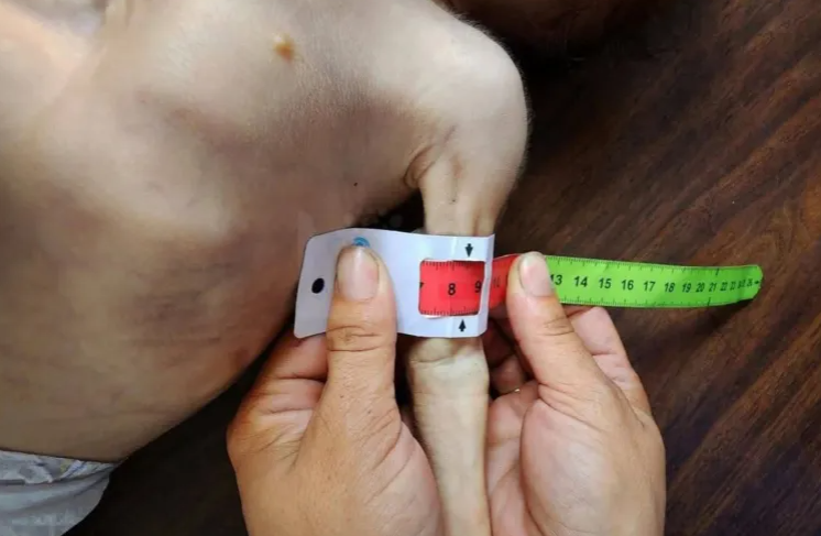 سنتيمترات معدودة ..  أذرع أطفال غزة تختصر حجم مأساة الجوع