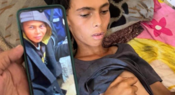 وفاة فتى بسبب الجوع وسوء التَّغذية في غزَّة  