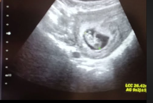 جنين عمره 40 عاما  ..  آلام في بطن ثمانينية تكشف المفاجأة!