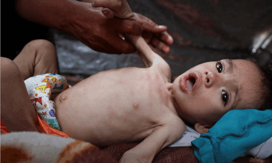 تفشّ خطير للحمّى الشوكيّة بين الأطفال في قطاع غزّة