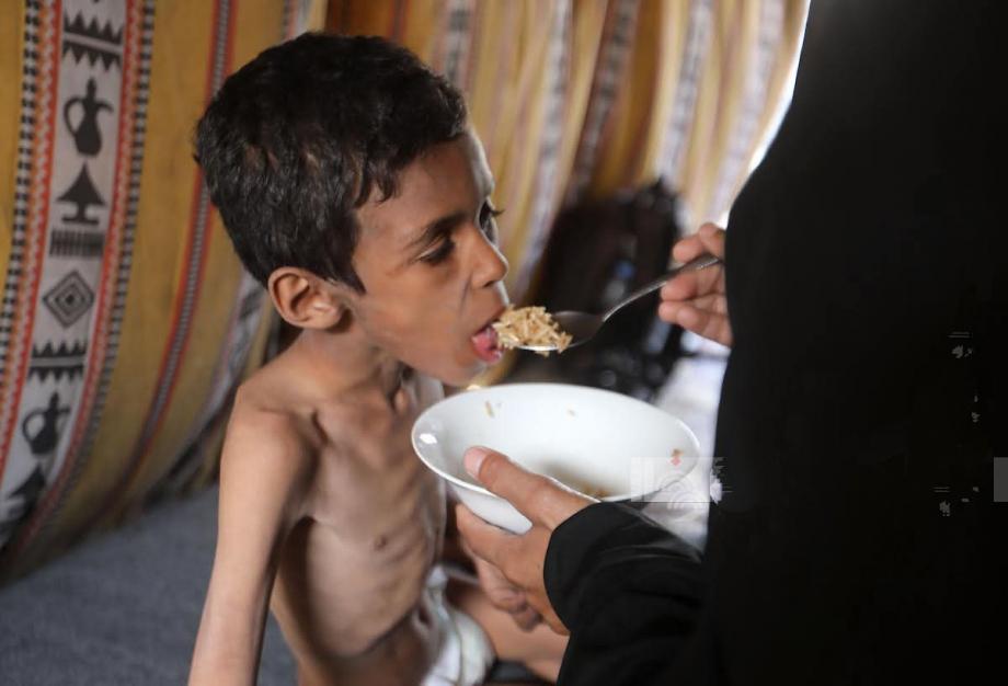 الطفل محمد السوسي يصارع المرض والجوع داخل خيمة نزوح 
