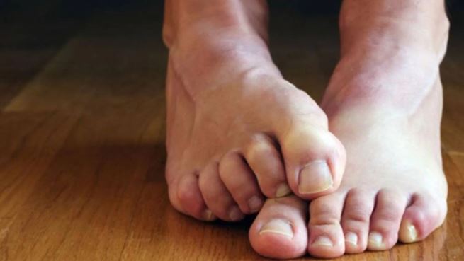 تغيرات في القدم قد تكشف عن إصابتك بأمراض خطيرة