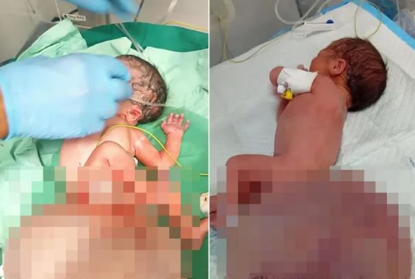 طفلة تولد بورم نادر بغزة ..  صرخة حياة تصبح شاهدا على الكارثة الإنسانية