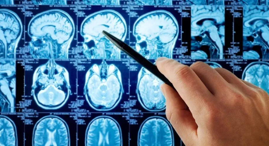 كيفية التعرف على ارتجاج الدماغ في الوقت المناسب