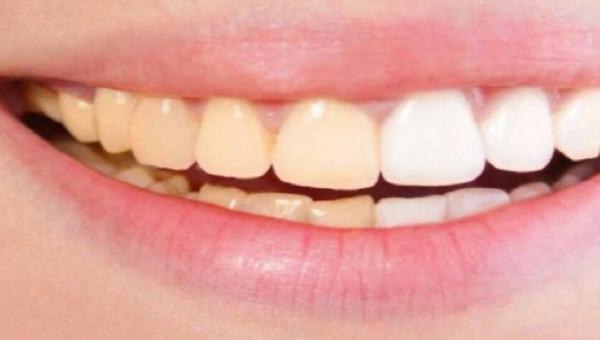 أسباب تغير لون الأسنان وطرق استعادة بياضها