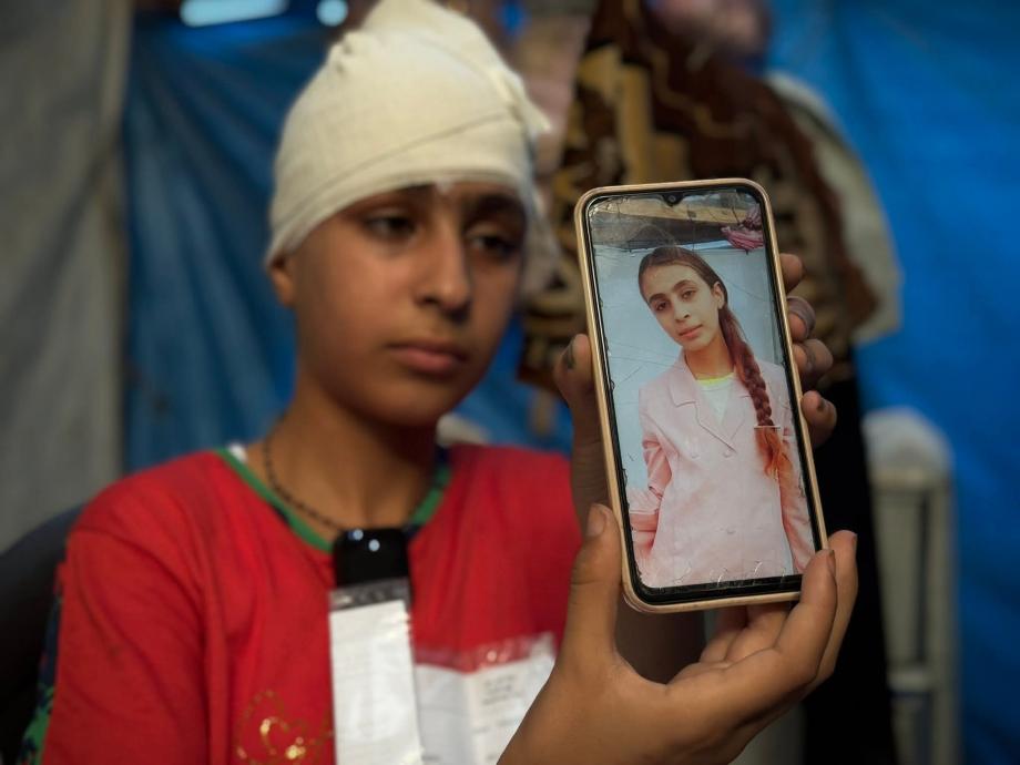 انخلعت فروة رأسي" ..  "هلا" طفلة تواجه الجحيم في خيمة النُّزوح  