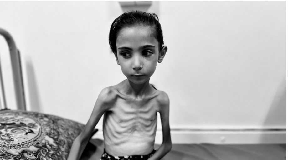 أمال البيوك ..  طفلة تتحول إلى هيكل عظمي تحت وطأة المجاعة  
