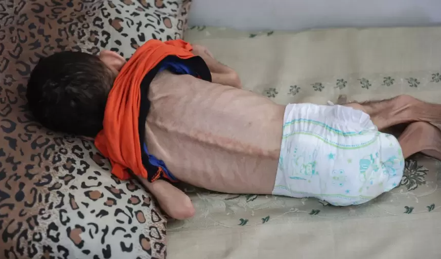  براءة في مواجهة الموت ..  سوء التغذية يهدد حياة الطفل بربخ  