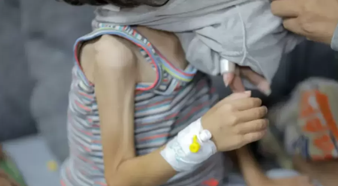 "المكمِّلات الغذائية ممنوعة"  ..  آلاف الأطفال مهدَّدون بسوء تغذية قاتل في غزَّة 
