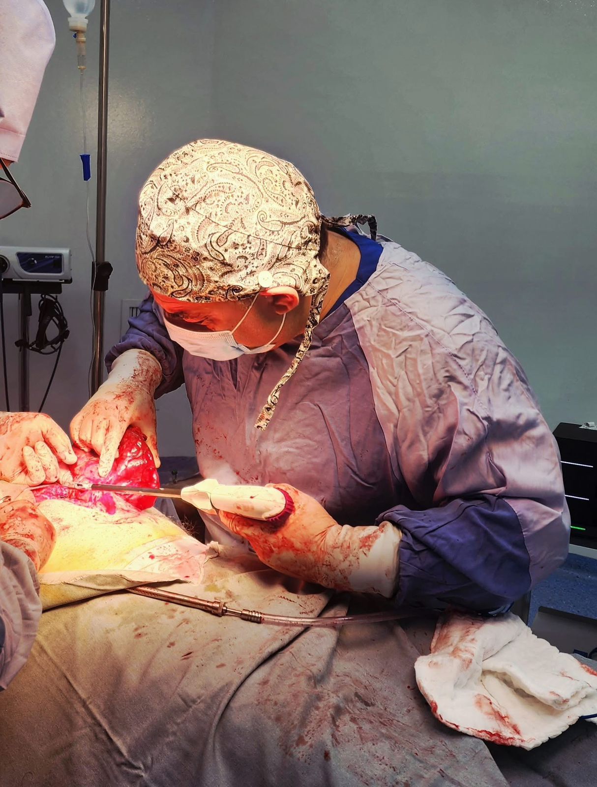 حالة فريدة: الدكتور نضال شواقفة ينجح في استئصال أكياس كلابية من كبد وطحال مريض في المفرق