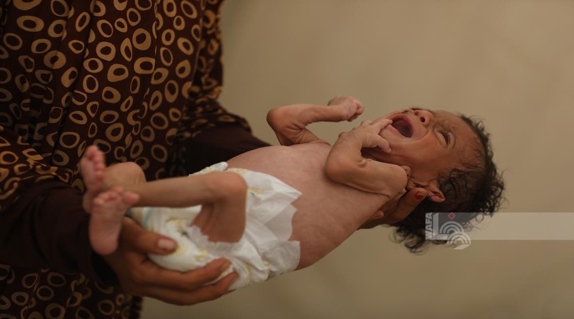 غزة  .. 11 حالة وفاة جديدة نتيجة المجاعة وسوء التغذية